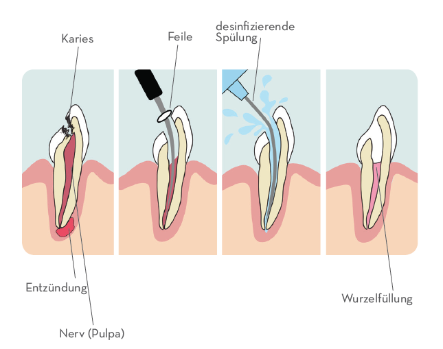 Vorgehensweise Wurzelkanalbehandlung